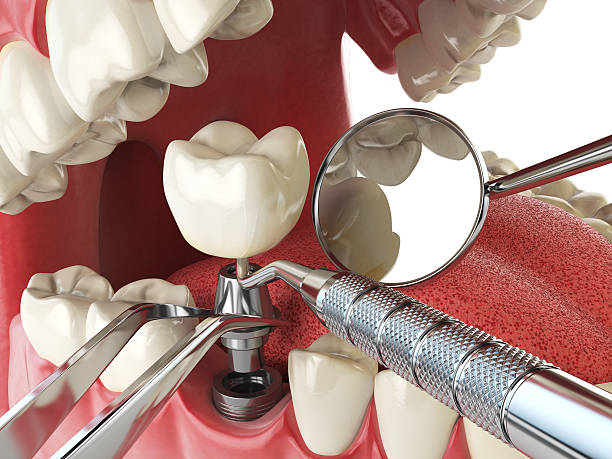 Best Emergency Dental Care for Abscessed Tooth in Colleyville, TX